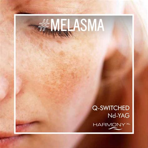 Tratamiento Del Melasma Con L Ser Q Switched Cutaneo Dermatolog A