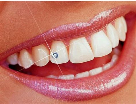 Dental Jewellery In Pune Dental Jewellery At Affordable Cost World