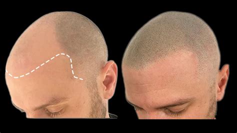 The Benefits Of Scalp Micropigmentation Cncsmp