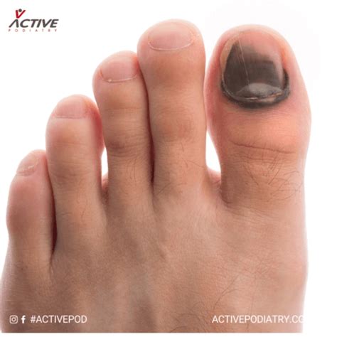 What Causes Black Toenails And How To Prevent Them Active Podiatry