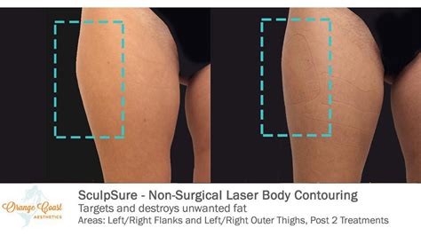 SculpSure Before and After Photos - Orange Coast Aesthetics