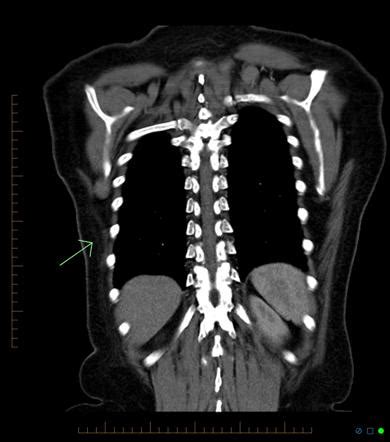 Long Subscapular Nerve Palsy Post Axillary Nodal Clearance Producing