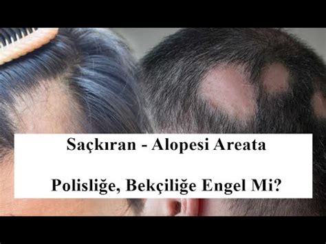 Saçkıran Alopesi Areata Polisliğe Bekçiliğe Engel Mi YouTube