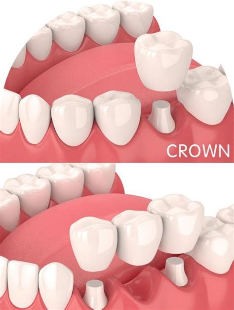 Crown And Bridges Dentist Barrow In Furness Barrow Dental