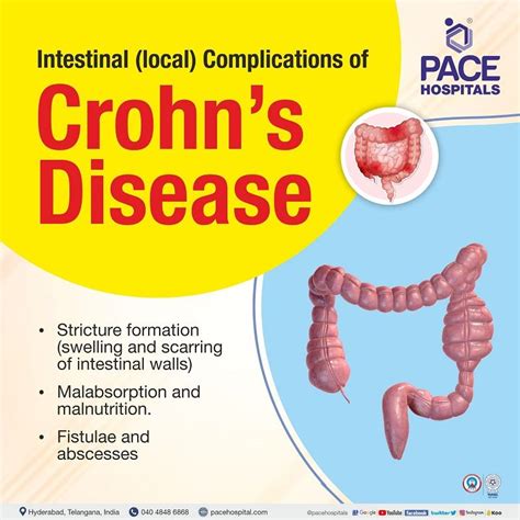 Crohn S Disease Symptoms Causes Complications Prevention