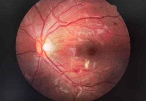 Qué es la Retinopatía Hipertensiva Área Oftalmológica Avanzada