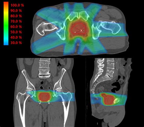 Radiation Therapy Imrt Prostate Cancer