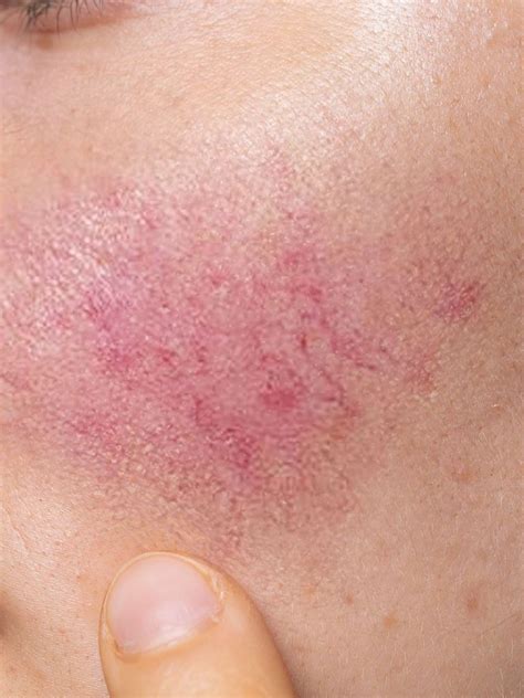 Rosacea Treatments Mesa AZ Sagebrush Dermatology