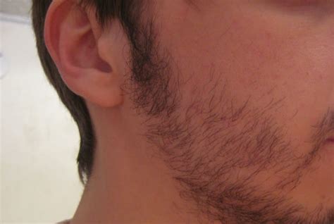 5 Ways To Fix Your Patchy Beard Hair Transplant Dubai