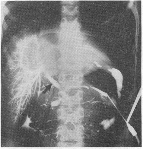 CONGESTIVE SPLENOMEGALY (BANTI'S SYNDROME) DUE TO PORTAL STENOSIS. | Semantic Scholar