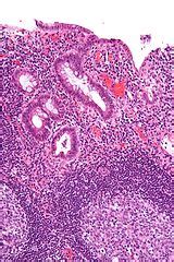 Diversion colitis - Libre Pathology