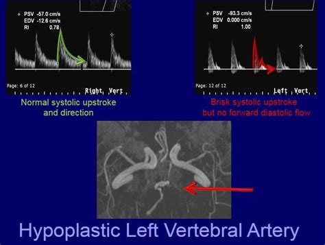 Hypoplastic left vertebral artery | Vertebral artery, Vascular ultrasound, Ultrasound