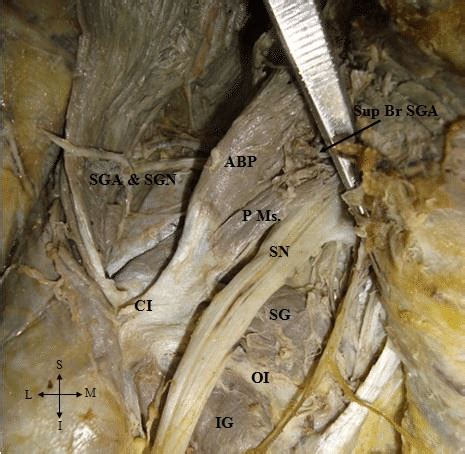 Dissected left gluteal region (SGA: Superior gluteal artery, SGN ...