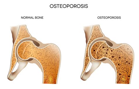 Osteoporosis vs. Osteopenia: What's the Difference?