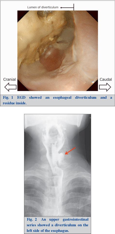 Figure 1 from A Case of Killian-Jamieson Diverticulum Resected Using ...