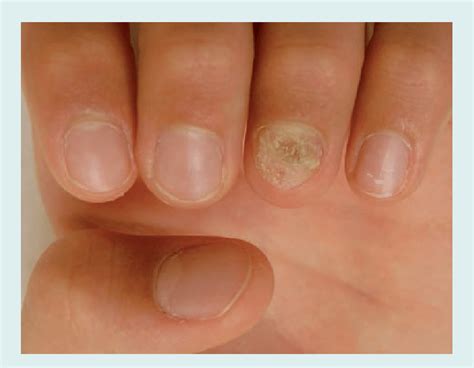 Pictures Of Nail Psoriasis - Nail Ftempo