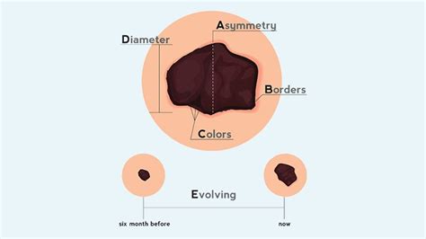 Malignant Melanoma Symptoms - Doctor Heck