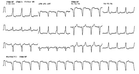 WPW syndrome (anteroseptal pathway)