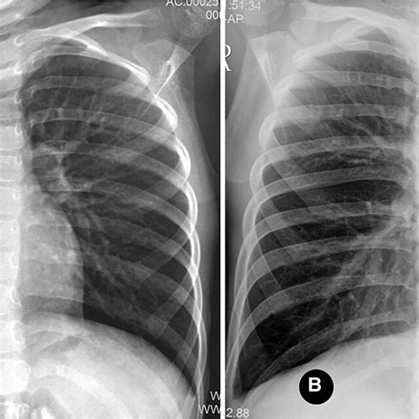 Right Proximal Interruption Of The Pulmonary Artery With Left Sided