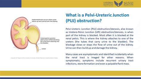 Successful A-H Pyeloplasty for PUJ Obstruction in a Duplex Kidney - Dr ...