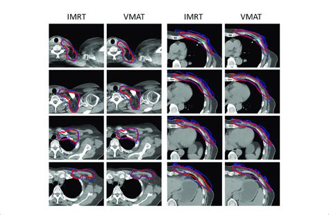 Dose Distribution In The Target With The Use Of Ass Vmat Plans