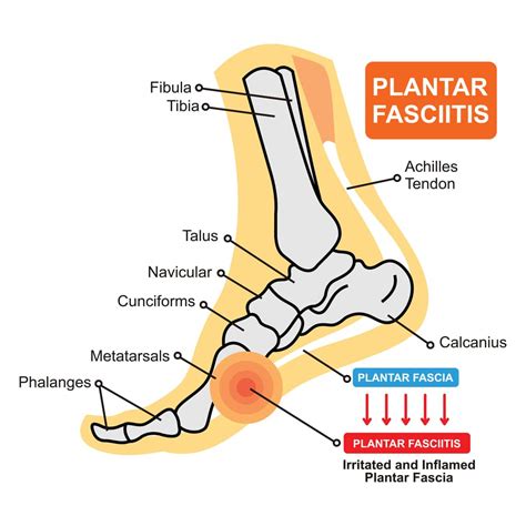 How To Wrap Your Foot For Plantar Fasciitis Recommended Tips Tricks