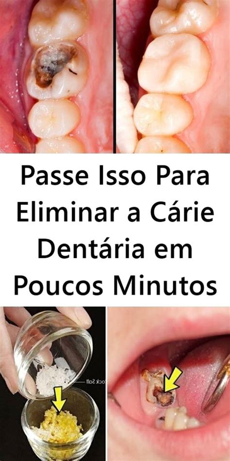 Passe Isso Para Eliminar A Cárie Dentária Em Poucos Minutos Cárie