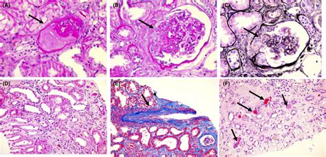 Renal Biopsy Demonstrating Sclerotic Glomeruli A Focally Segmentally