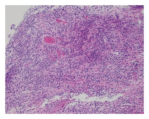 Nonspecific Histologic Findings Included Granulation Tissue And Download Scientific Diagram