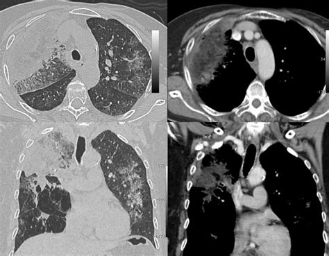 Lipoid Pneumonia - CT Chest Review