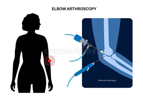 Arthroscopy Stock Illustrations 179 Arthroscopy Stock Illustrations