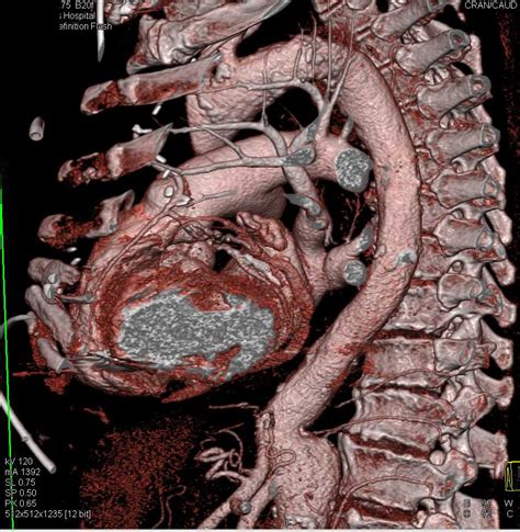 Aortic Dissection Ct Scan