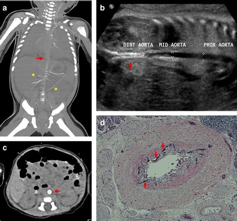 Clinical Images Of Vascular Calcifications In Patients With GACI A