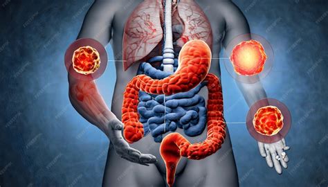 Problemas No Intestino Grosso - Inflamação bacteriana do intestino grosso e delgado Câncer de cólon ...