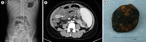 Surgically Treated Gallstone Ileus 22 Years After Kasai