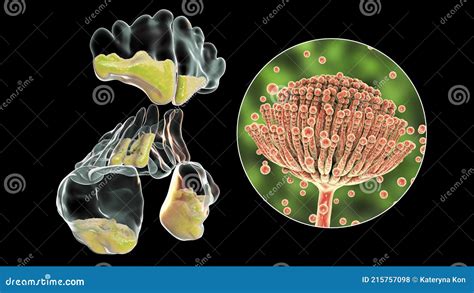 Aspergillus Fungi As A Cause Of Sinusitis 3d Illustration Showing