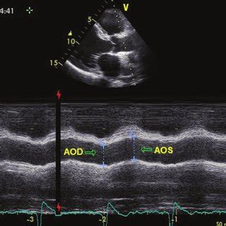 The Systolic And Diastolic Diameters Measurements Of The Ascending