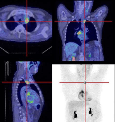 Determination Of Radiotherapy Target Volume For Esophageal Cancer Liu