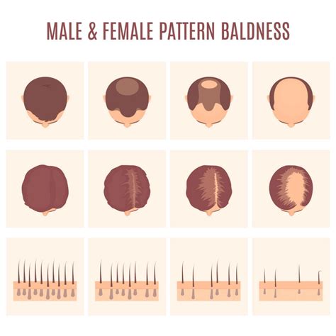 Female Pattern Baldness Symptoms And Treatment Artofit