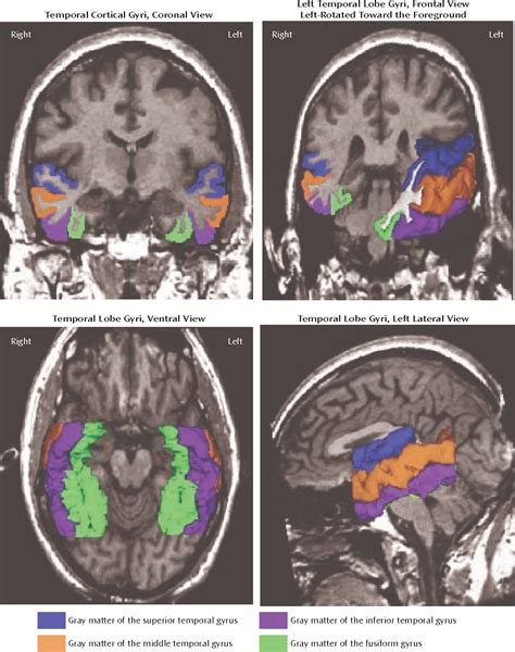 Figure 2 From Middle And Inferior Temporal Gyrus Gray Matter Volume