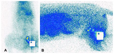 Lymphatics Free Full Text The Role Of Sentinel Node Mapping And