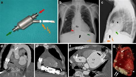 A Year Old Male Patient With A Berlin Heart Incor Lvad As A