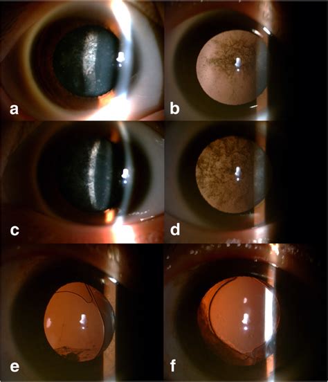 A Novel Mutation In The Oar Domain Of Pitx3 Associated With Congenital Posterior Subcapsular