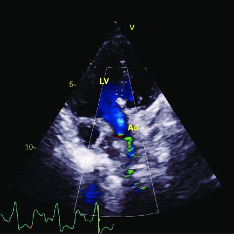 Postoperative Transthoracic Echocardiography Image In Four Chamber View