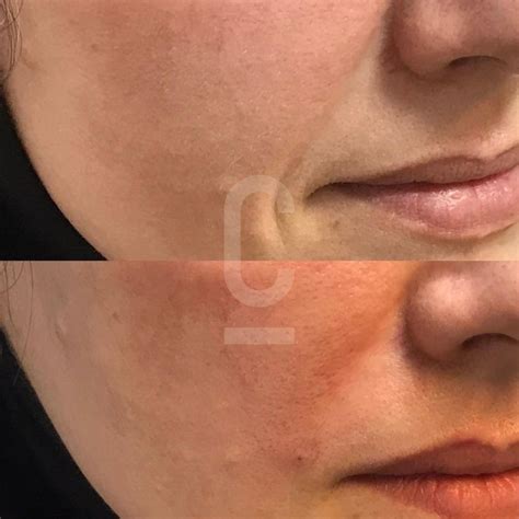 Nasolabial Fold Filler Sydney Cosmetic Connection