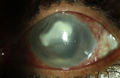 Contact Lens Induced Pseudomonas Keratitis Following Descemet Stripping Automated Endothelial