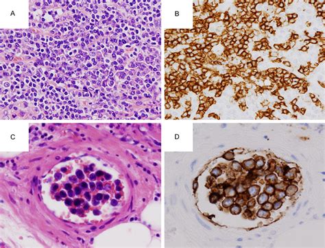 A Inguinal Lymph Node Biopsy Sample He Staining Plasmacytoid Small