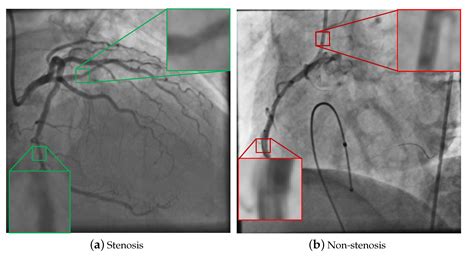 Mathematics Free Full Text Transfer Learning For Stenosis Detection