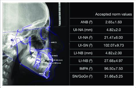 Angular And Linear Cephalometric Measurements And Accepted Normal Values Download Scientific