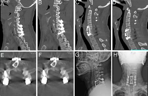 Figure 9 From Acute Spinal Epidural Abscess Of The Cervical Spine